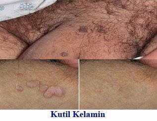 Illustration for article titled Menghilangkan Kutil Kelamin